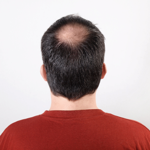 skicore haie treatment - genetics hair loss
