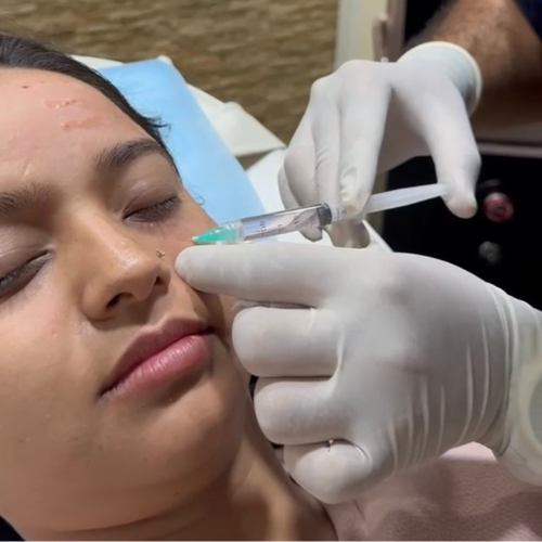 Under Eye Pigmentation