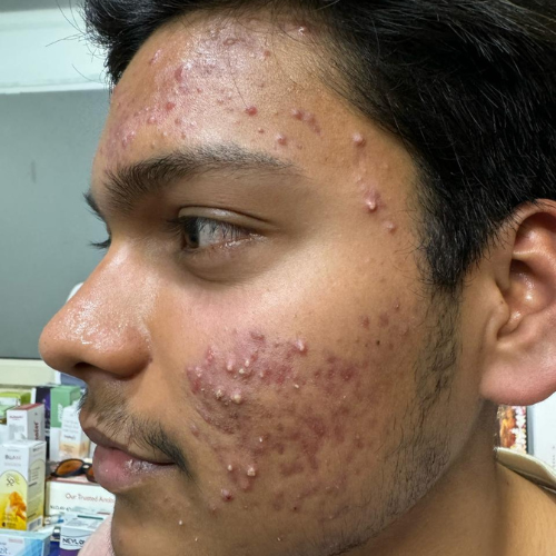 Acne & Acne Scar Treatment