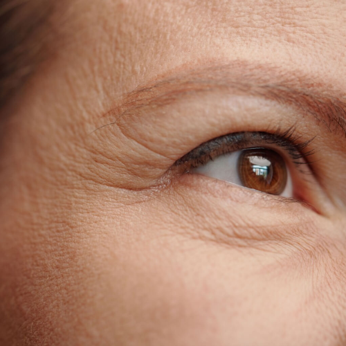 Wrinkles & Fine Lines