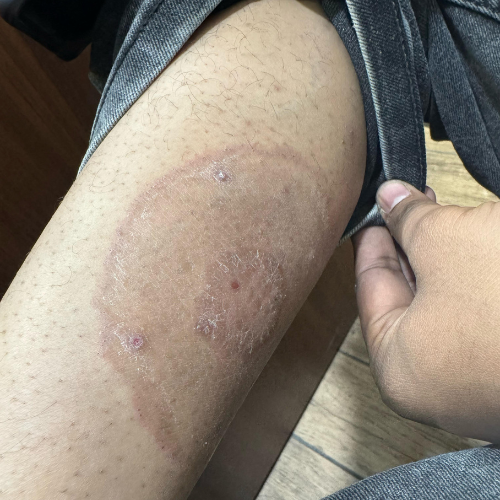 Skin Allergies & Reactions