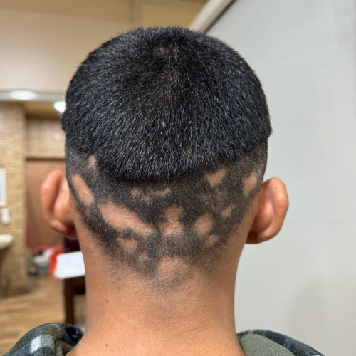Alopecia Areata Treatment