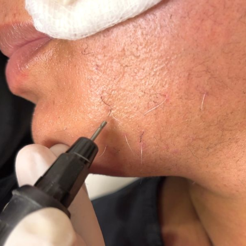 Electrolysis for White Hair