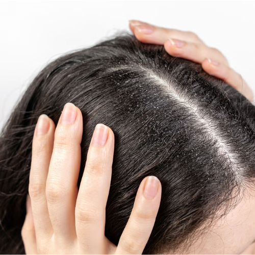 Dandruff & Scalp Disorders