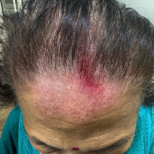Scalp Allergies & Infections