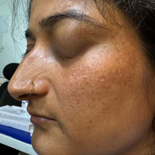 Melasma & Pigmentation Treatment
