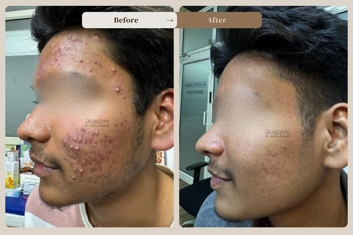Skincore Before after 1