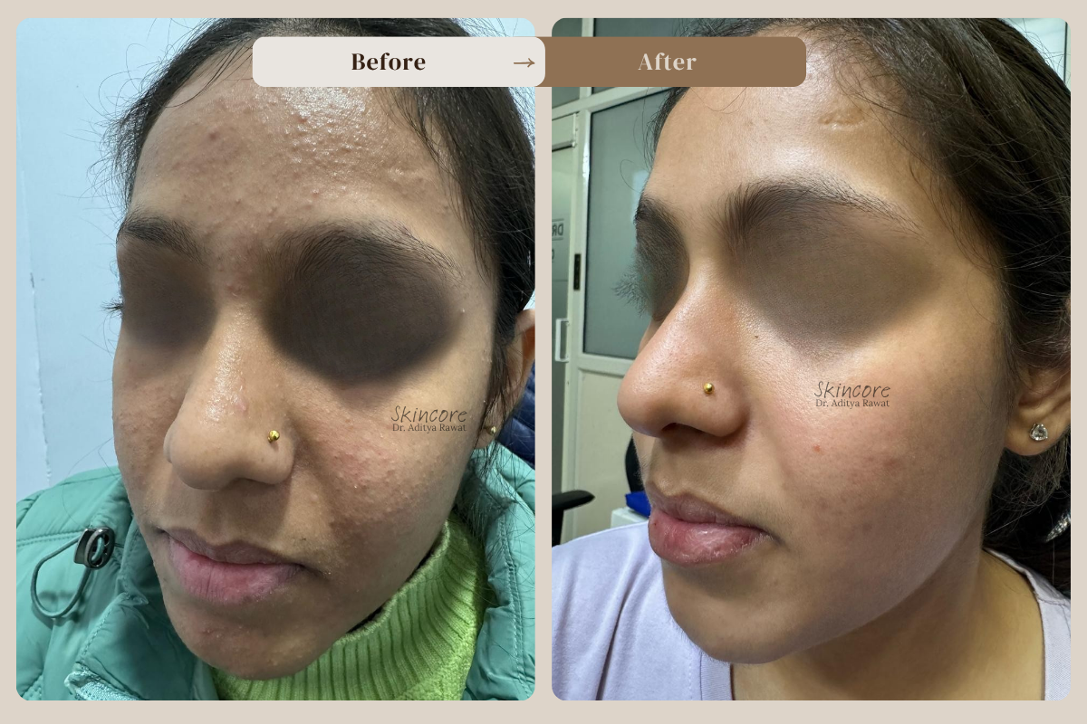 Skincore before after treatment