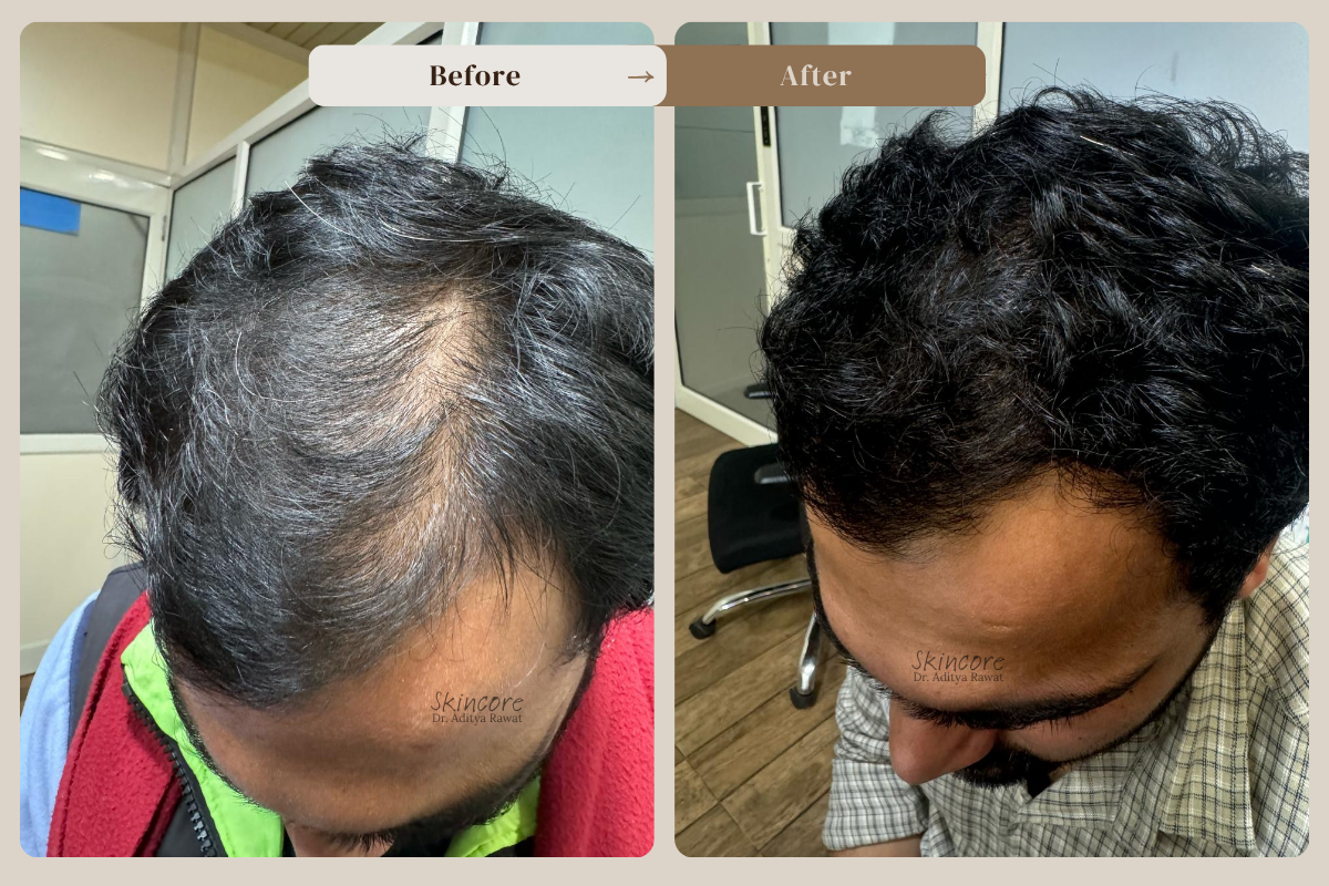Skincore before after treatment