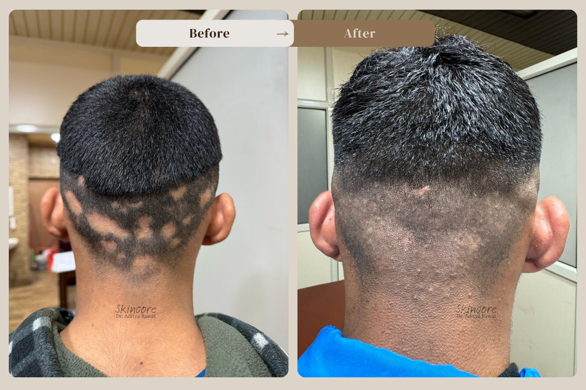 Skincore before after treatment