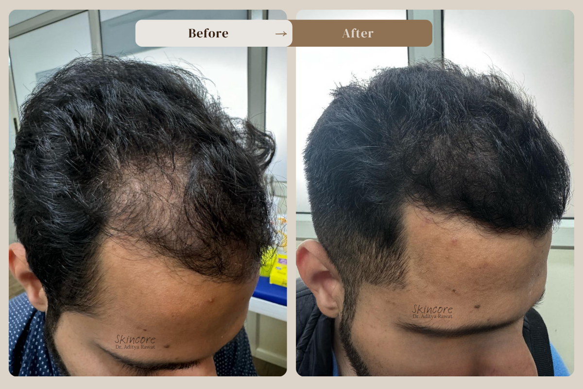 Skincore before after treatment