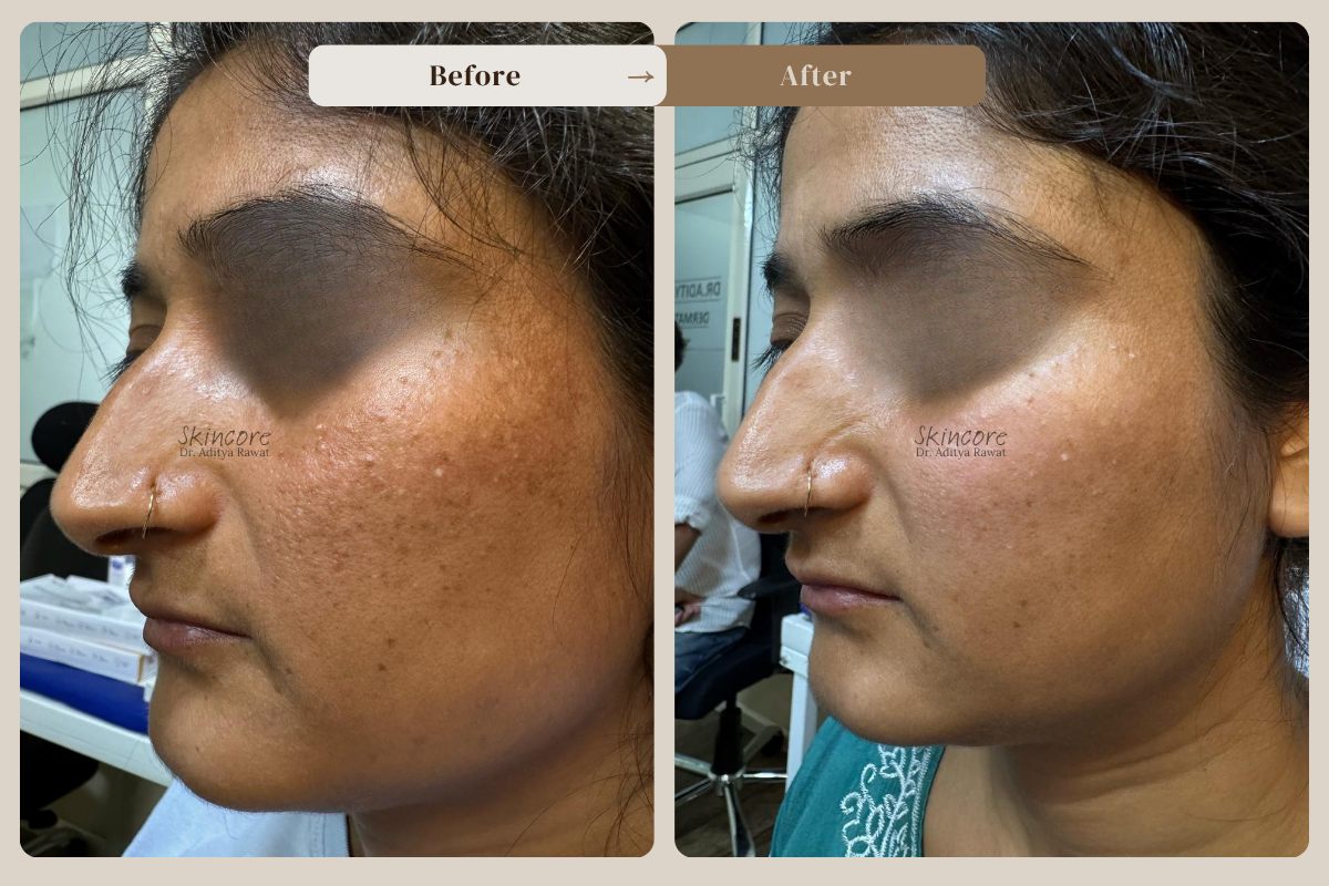 Skincore before after treatment