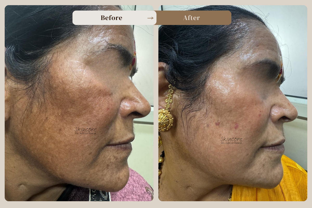 Skincore before after treatment