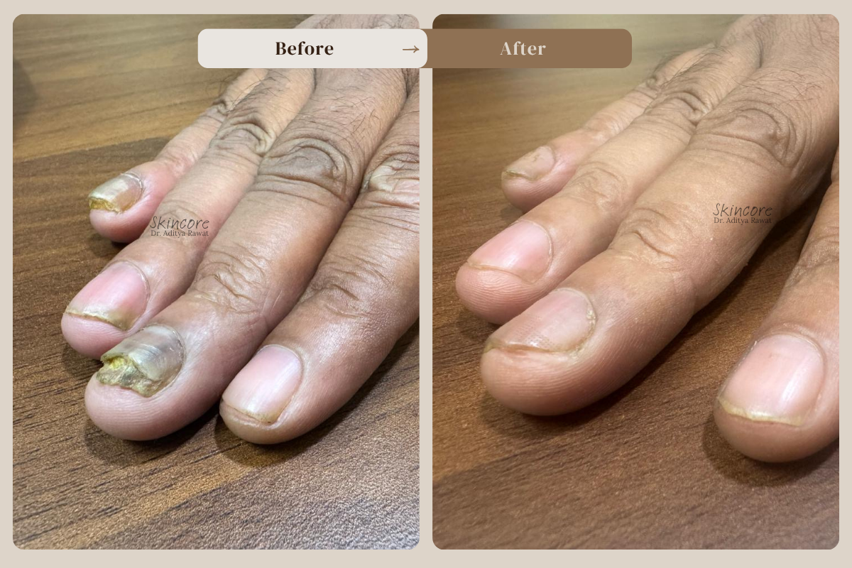 skincore before after