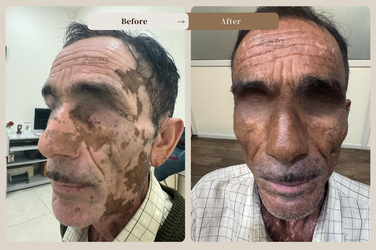 Skincore before after treatment